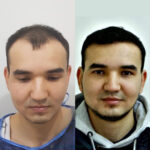 FUE Hair Transplant in Islamabad