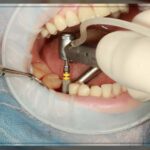 bes-implantologist-dubai