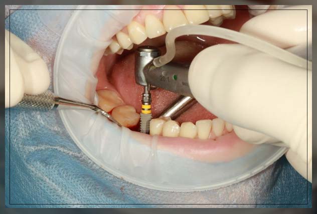 bes-implantologist-dubai