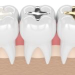 dental filling in islamabad