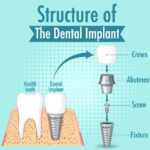 dentalimplants-1 (1)