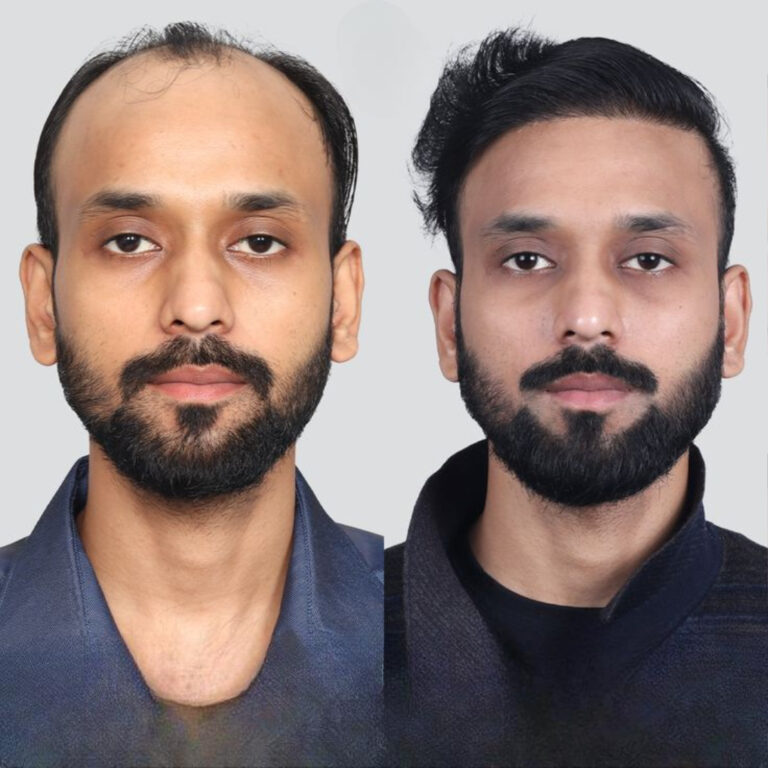 hair transplant
