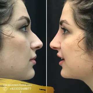 Rhinoplasty in Islamabad