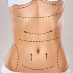 Tummy Tuck in Islamabad