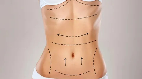 Tummy Tuck in Islamabad