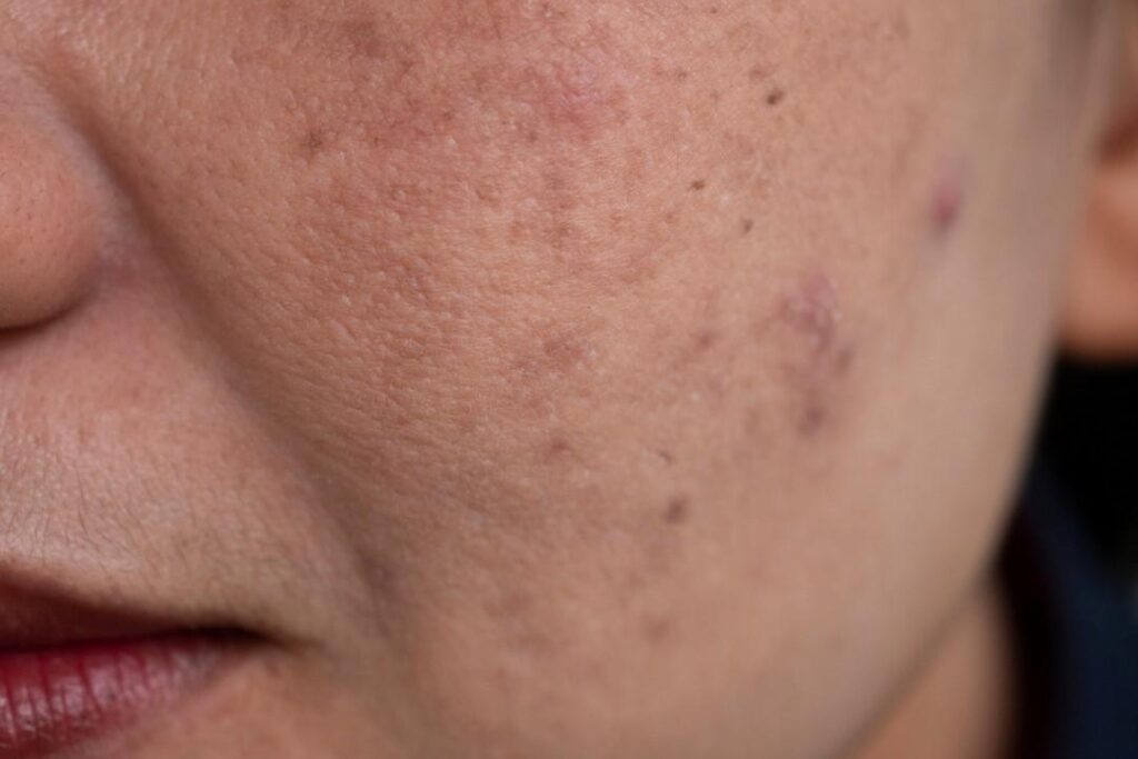 melasma treatment in Islamabad