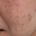 melasma treatment in Islamabad