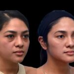 Dark Circles Treatment in Dubai