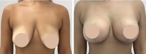 Breast reduction in Dubai
