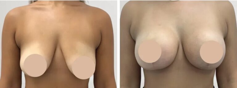 Breast reduction in Dubai