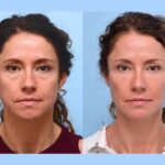 Trusted Thread Lift Treatment in Dubai for Facial Firmness