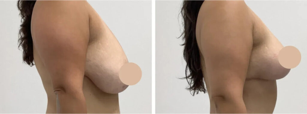 Breast Lift Surgery in Dubai
