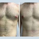Gynecomastia