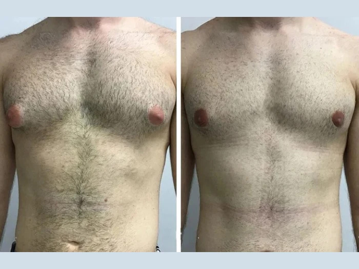 Gynecomastia