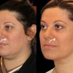 Sculptra fillers in dubai