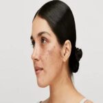 Top-Rated Melasma Treatment in Riyadh for Smooth Skin Texture