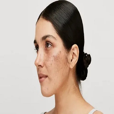 Top-Rated Melasma Treatment in Riyadh for Smooth Skin Texture