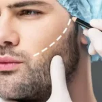 best-hair-transplant-in-dubai-1024x576