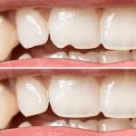 Revitalize Your Smile with Dental Bonding