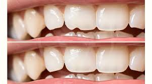 Revitalize Your Smile with Dental Bonding