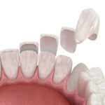 A Complete Solution for a Perfect Smile Dental Veneers