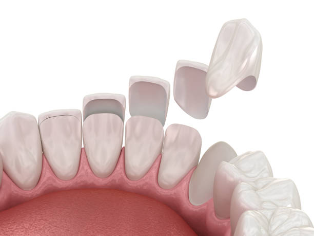 A Complete Solution for a Perfect Smile Dental Veneers