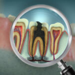 Root Canal Treatment in Islamabad: Keep Your Natural Teeth Healthy