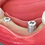 Gum Grafting in Islamabad: Protecting Your Smile at the Root Level