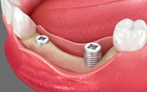 Gum Grafting in Islamabad: Protecting Your Smile at the Root Level