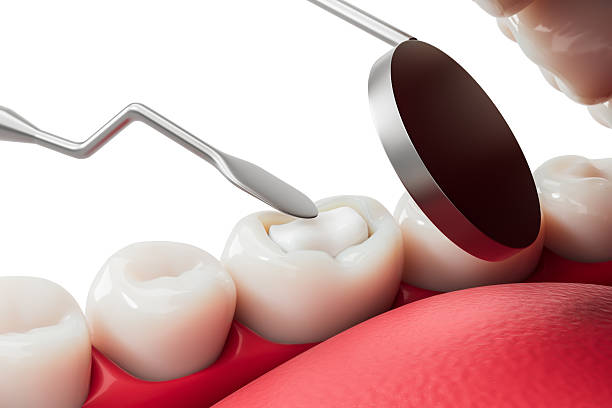 Protect Your Smile with Professional Dental Fillings