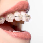 Teeth Braces in Islamabad: Your Path to a Confident, Healthy Smile