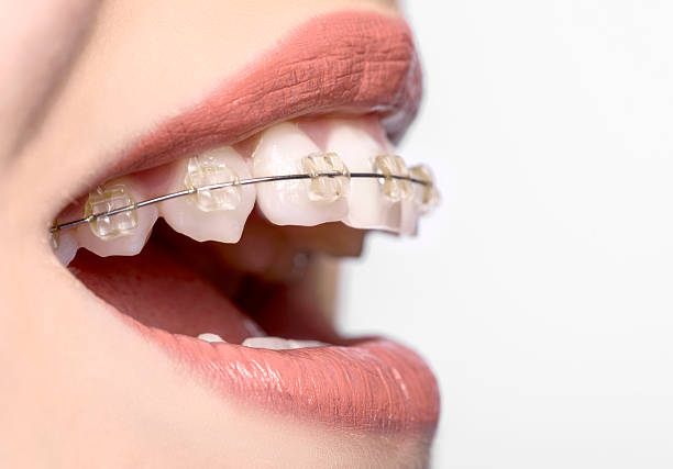 Teeth Braces in Islamabad: Your Path to a Confident, Healthy Smile