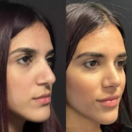 rhinoplasty in dubai
