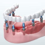 Dental Implants Cost in Houston