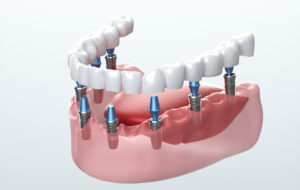 Dental Implants Cost in Houston