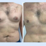 Gynecomastia in dubai