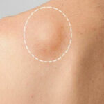 lipoma treatment in Islamabad