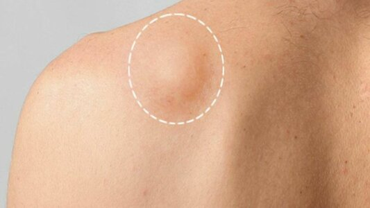 lipoma treatment in Islamabad