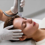 RF-Microneedling-Exosome-Therapy-for-Skin-Rejuvenation-Hair-Loss-Treatment-London