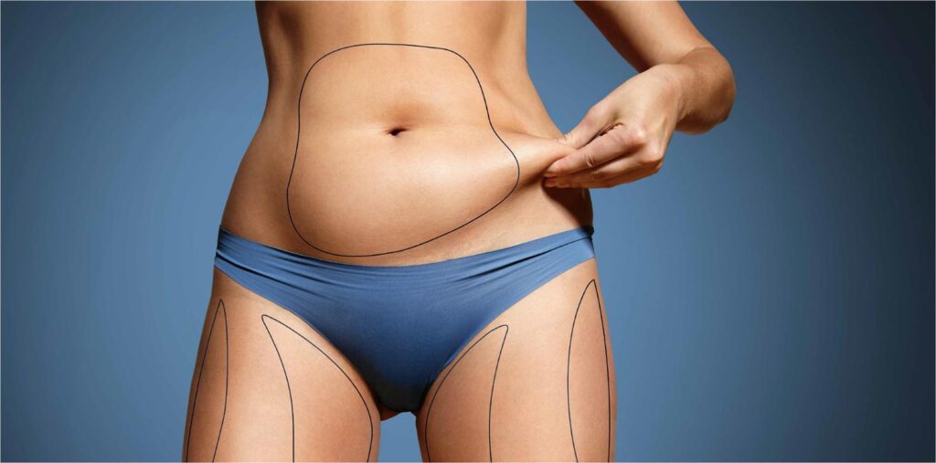 Best abdominoplasty Dubai