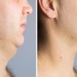 chin lip treatment