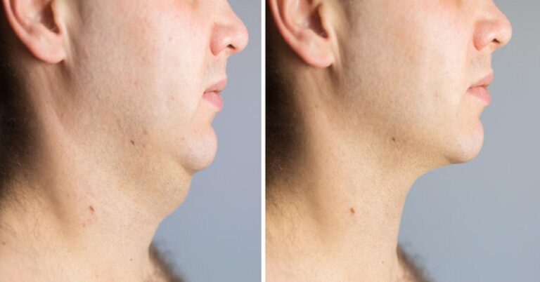 chin lip treatment