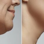 double chin liposuction