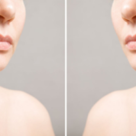 double chin liposuction