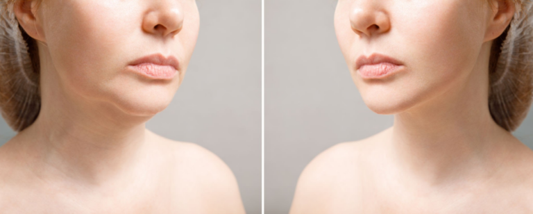 double chin liposuction