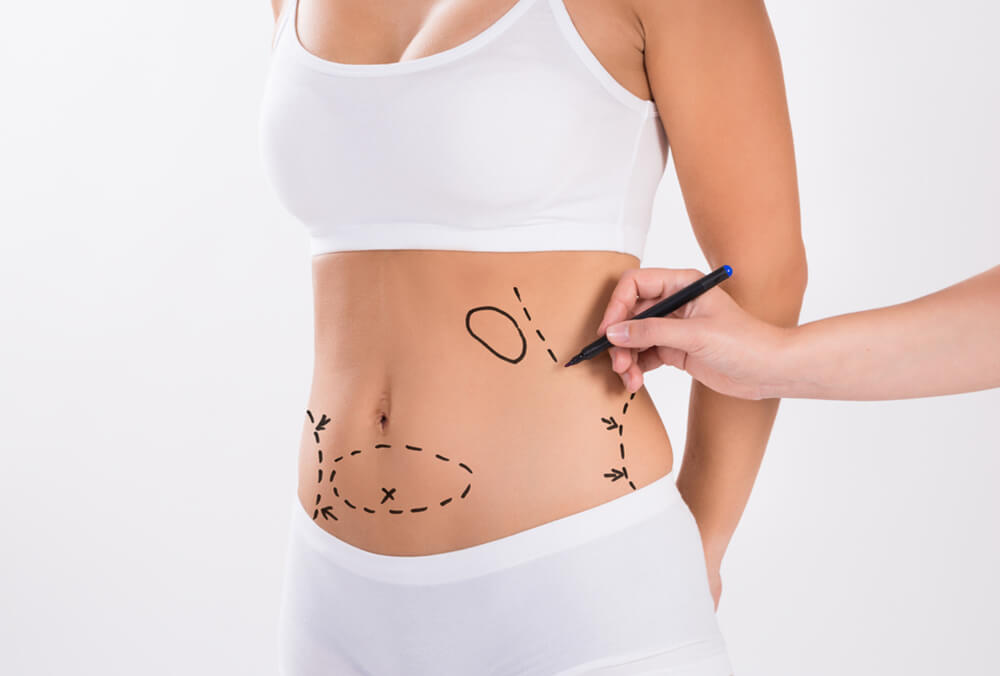 liposuction in Dubai
