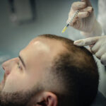 Complete Guide to Hair Loss Treatment in Islamabad