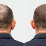 Hair Transplant in Riyadh