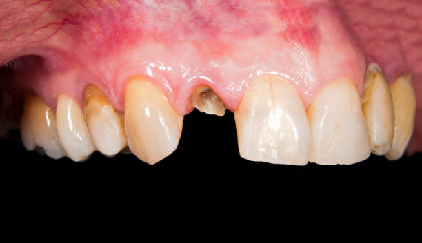 Restore Broken Teeth Effectively: Tooth Fracture Treatment in Islamabad