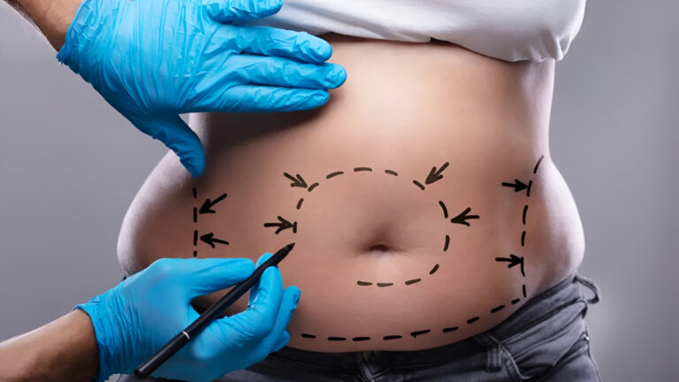 laser liposuction in Islamabad